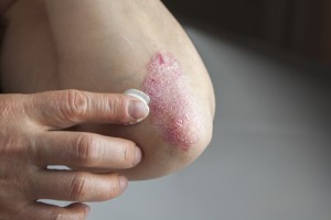 Psoriasis on elbow. Medical treatment